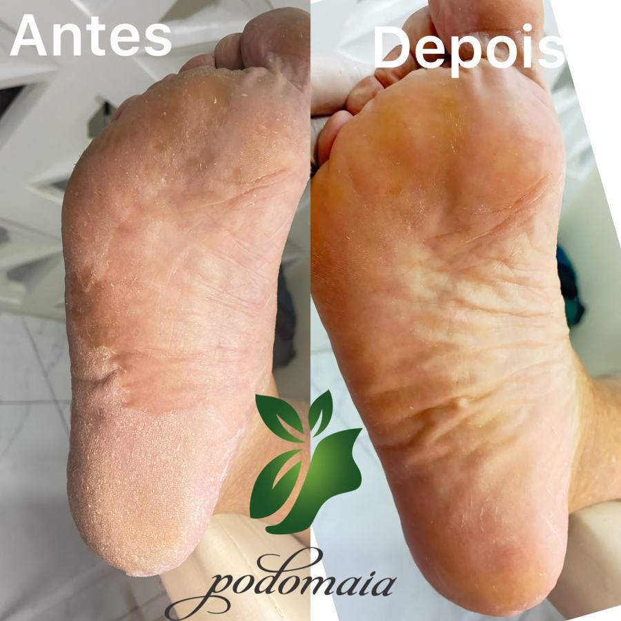 Comparação real de cuidado da pele dos pés, antes à esquerda e depois à direita